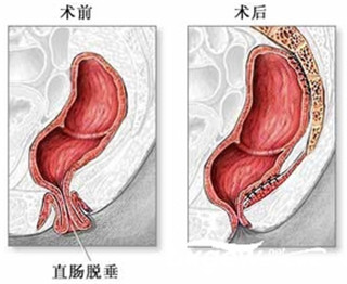 阜阳兆岐肛肠医院