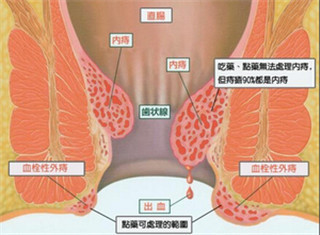 阜阳兆岐肛肠医院